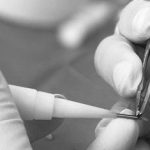 injerto capilar Madrid