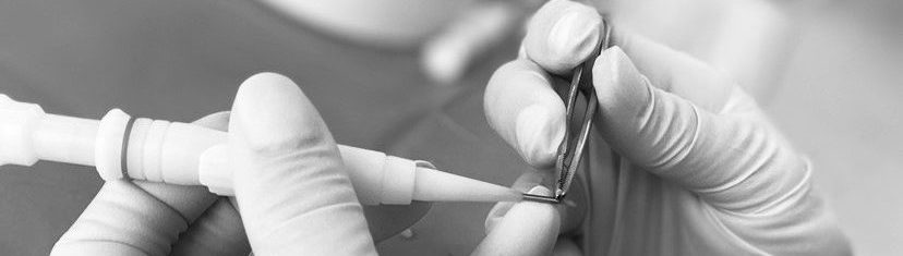 injerto capilar Madrid injerto capilar Madrid