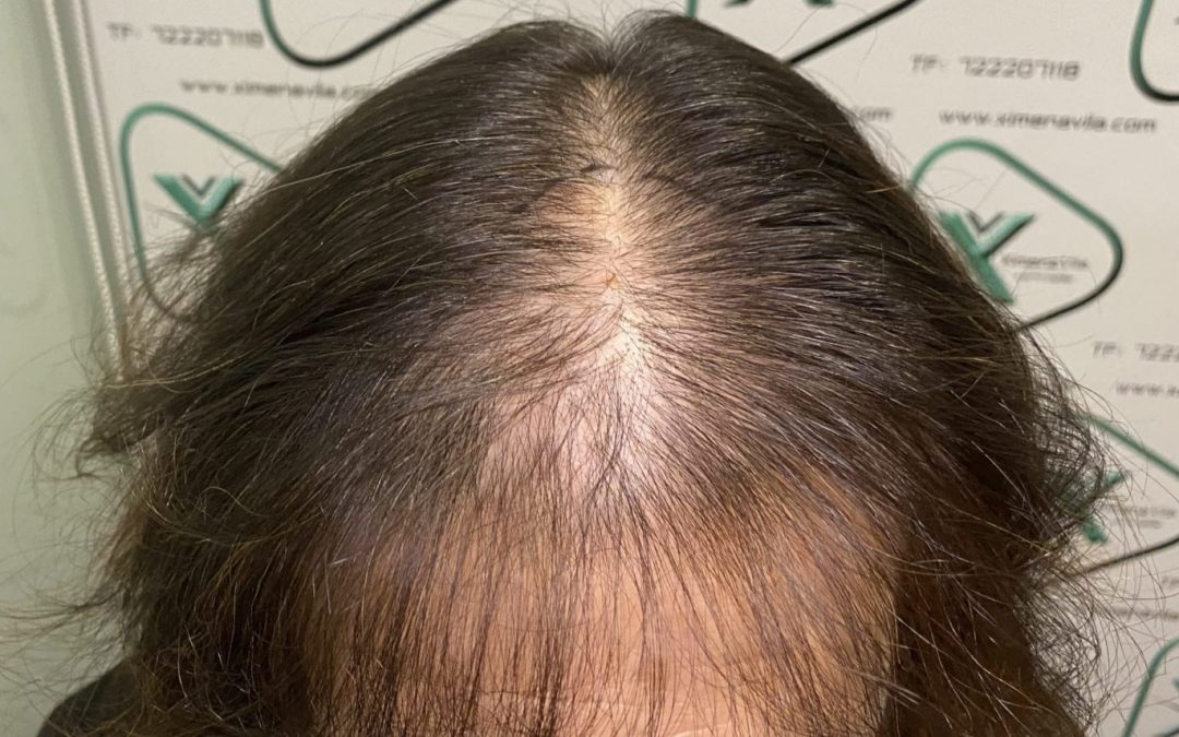 Caída del cabello en mujeres, ¿existe una solución?