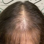 caída cabello mujeres