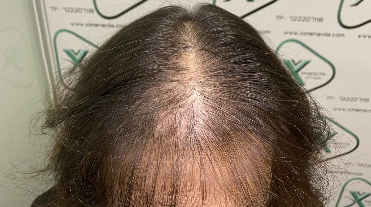 caída cabello mujeres caída cabello mujeres