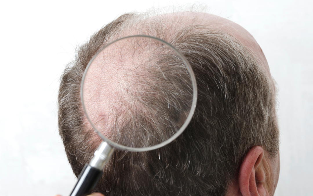 Alopecia difusa: qué es y por qué se produce