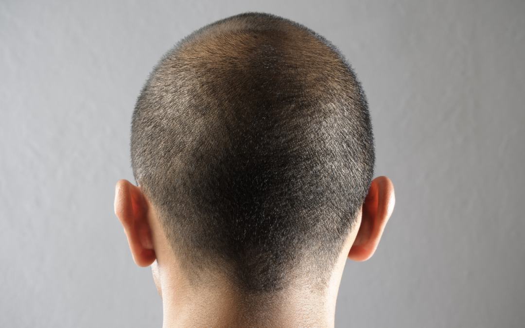 Zona donante en el injerto capilar: todo lo que tienes que saber