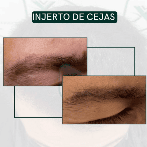 Técnica FUE para injerto de cejas