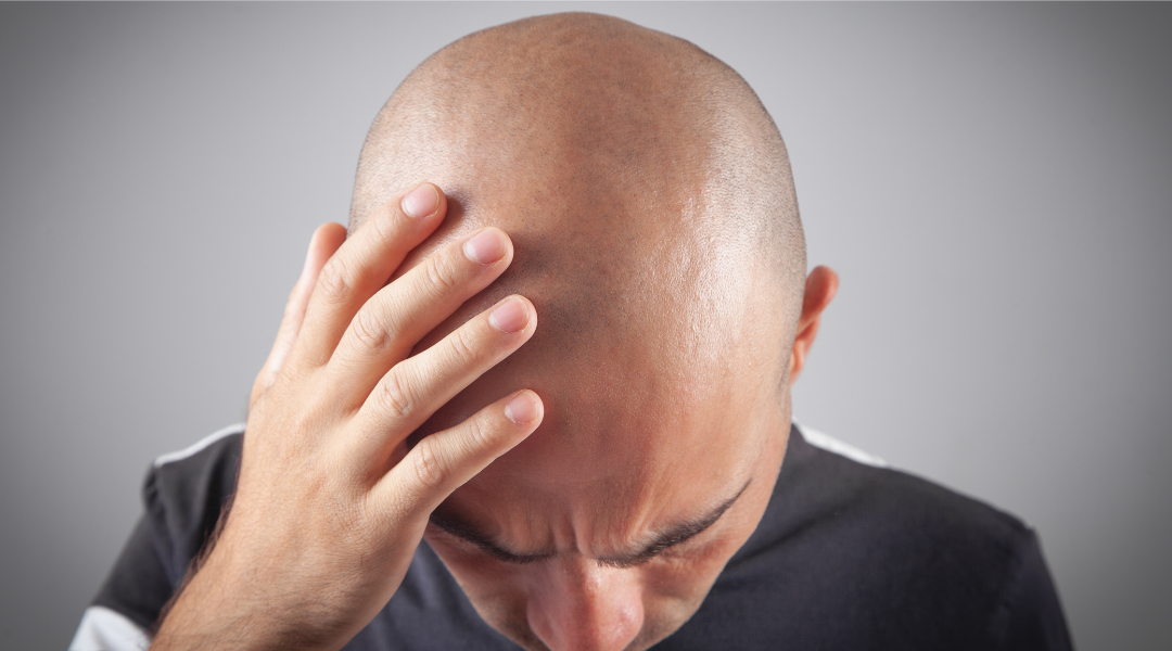 ¿Cuánto tarda en crecer el pelo tras un injerto capilar? Fases mes a mes