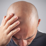 ¿Cuánto tarda en crecer el pelo tras un injerto capilar? Fases mes a mes