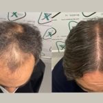 Intervención capilar de frontal y coronilla