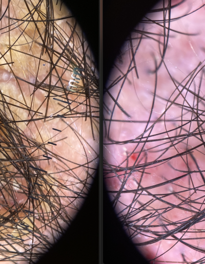 Intervención capilar de frontal y coronilla