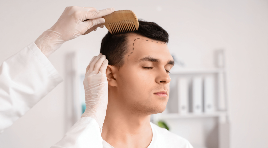 ¿Es normal que se caiga el pelo después de un injerto capilar?