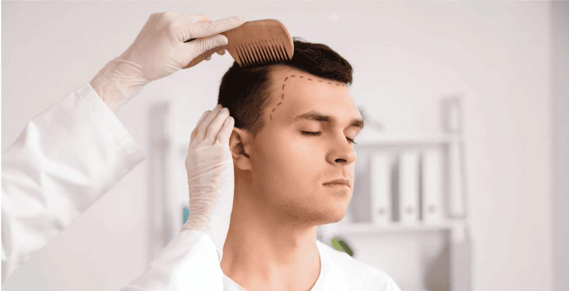 ¿Es normal que se caiga el pelo después de un injerto capilar ¿Es normal que se caiga el pelo después de un injerto capilar