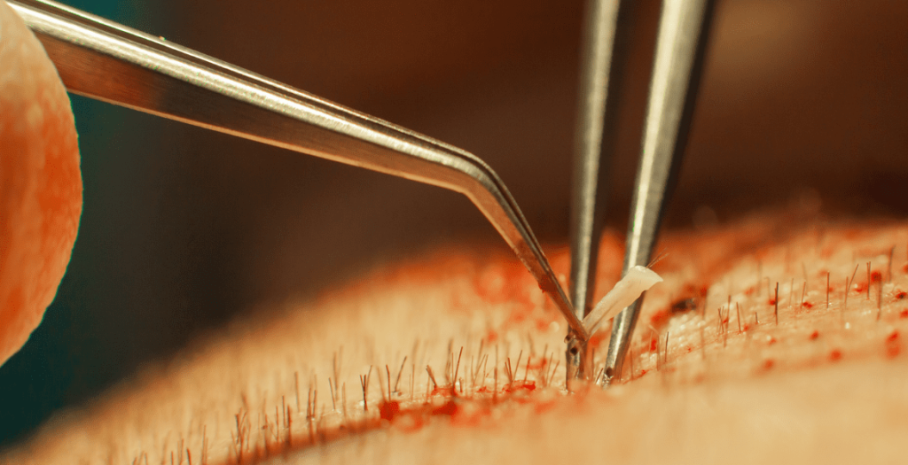 ¿Es normal que se caiga el pelo después de un injerto capilar (2)